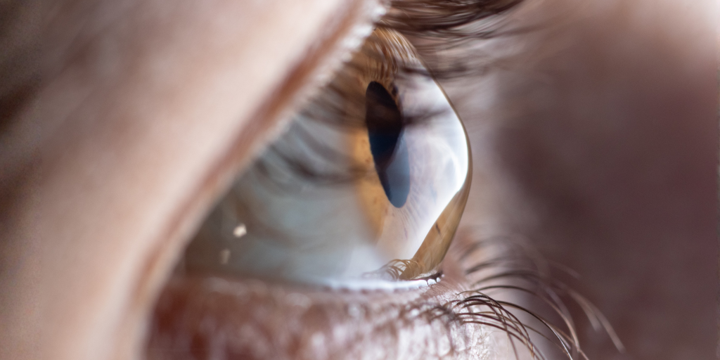 keratoconus
